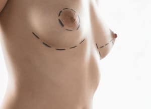 réduction mammaire turquie